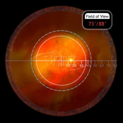 Central Retina ACS®